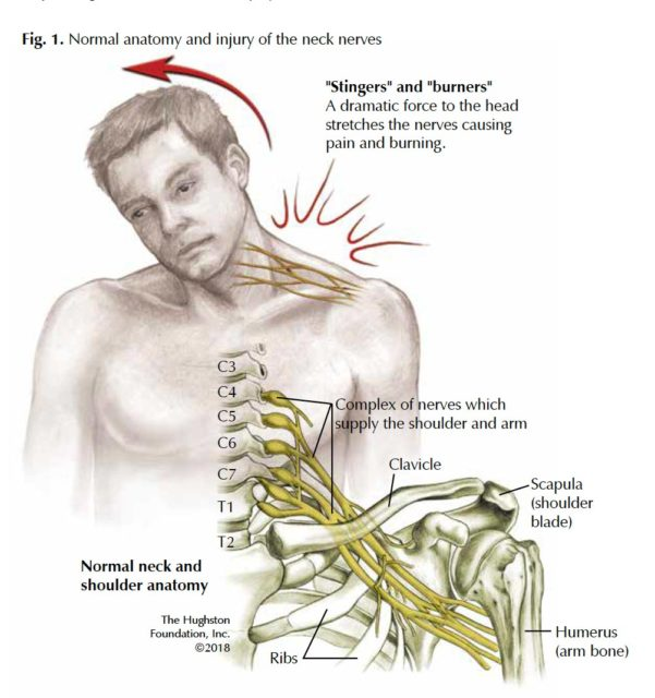 A drawing on a person having their neck stretched to one side, with a rendering of the nerves being stretched in that action. Below the figure is an anatomical sketch of the skeleton and nerves in the neck and upper shoulder.
