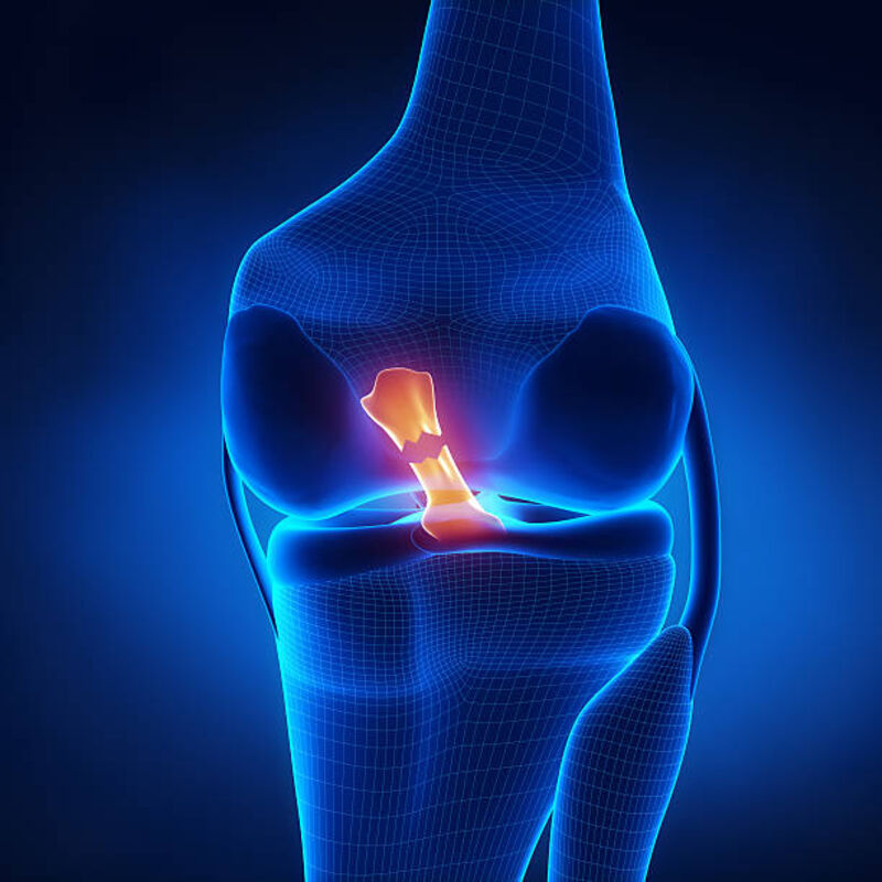 an xray image of a knee cap with a torn muscle