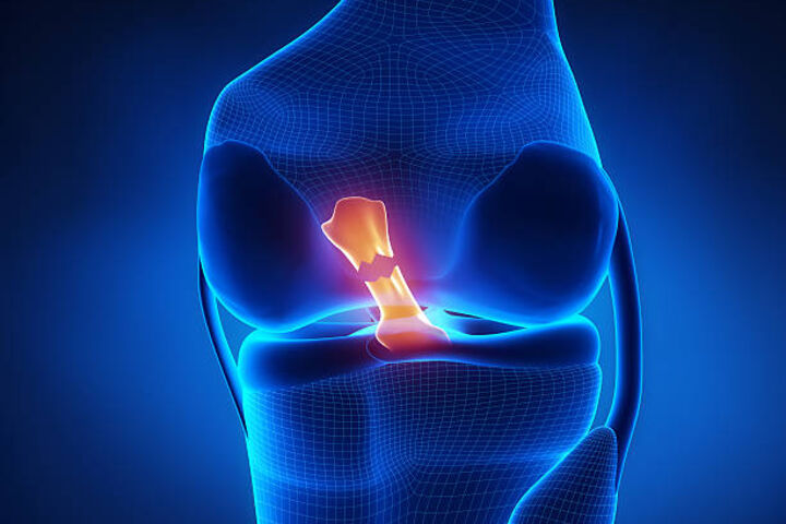 an xray image of a knee cap with a torn muscle